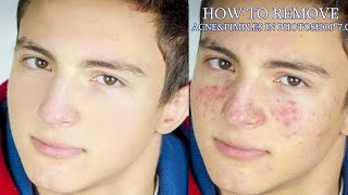 How To Remove Acne Pimples in photoshop 70 [upl. by Notnats128]