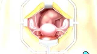 PreOp® Patient Education Hysterectomy Removal of Uterus Ovaries and Fallopian Tubes Surgery 3 [upl. by Paddie]