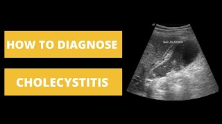 How to Diagnose Cholecystitis  Imaging Basics [upl. by Enohs]