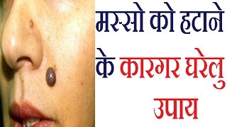 अनचाहे जिद्दी मस्से हटाने का रामबाण उपाय Masse Hatane Ka Gharelu Ilaj Warts Removal Tips in Hindi [upl. by Kilgore]