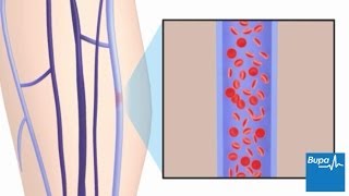 How superficial thrombophlebitis develops [upl. by Nitaf737]