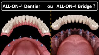 All on 4  Type de prothèse  Dentier ou Bridge [upl. by Ahael]