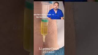 Bakers cyst treatment skincare dr Khaled Sadek explains [upl. by Ilzel]