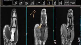 Case Review Young Patient with Thumb Injury on MRI [upl. by Keelby]