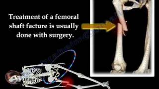 Fracture of the Femur and its fixation  Everything You Need To Know  Dr Nabil Ebraheim [upl. by Wandy]