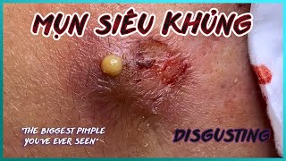 Big Cystic Acne Blackheads Extraction Blackheads amp Milia Whiteheads Removal Pimple Popping [upl. by Coralie]