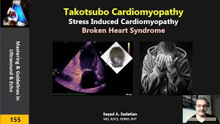 Takotsubo Cardiomyopathy or Broken Heart Syndrome [upl. by Eleynad]