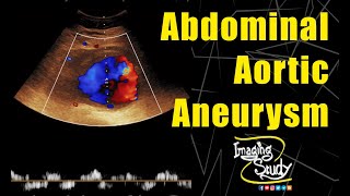 Abdominal Aortic Aneurysm  Ultrasound  Doppler  Case 139 [upl. by Ipoillak]