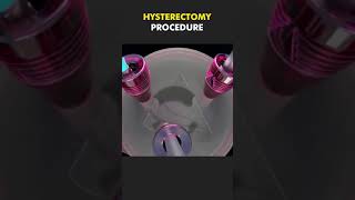 HYSTERECTOMY PROCEDURE 3D ANIMATION [upl. by Nnyladnarb]