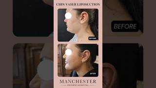 Chin Vaser Liposuction Before amp After ✨ See the Stunning Jawline Transformations ✨ chinliposuction [upl. by Adleremse]