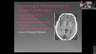 Stroke The Role of CT and MRI in Diagnosis and Treatment [upl. by Basilio]