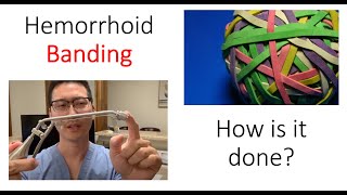 What is a hemorrhoid banding I show you how its done [upl. by Etaner]