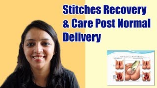 Post Normal Delivery Stitches Recovery amp Care Tips [upl. by Ax]