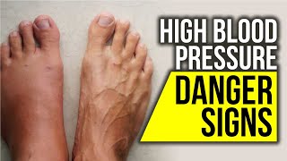 10 High Blood Pressure Signs That Might Mean DANGER [upl. by Ainaj]