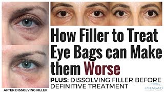 How Under Eye Fillers can Make Prominent Eye Bags Worse and Safely Dissolving Filler [upl. by Zarla]