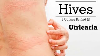 Urticaria Hives डाबर आउने समस्या के हो   DrRupak Ghimire [upl. by Adiam]