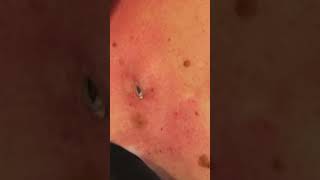 DILATED PORES OF WINER  PT 1 thedoc pimplepopper cyst blackheads satisfying dermatology [upl. by Philly]