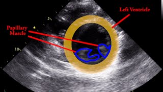 Papillary Muscle  Parasternal Short Axis [upl. by Amitak258]