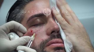 Belotero Fillers For Under Eye Hollows Dark Circles And Eye Bags  Dark Circle Treatment Live [upl. by Eirollam]