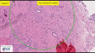 Ependymoma microscopy  Talking slide [upl. by Adyol]