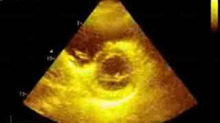 Pulmonary embolism echocardiography [upl. by Lynn34]