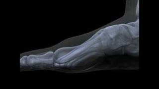 Hallux Limitus  Rigidus Surgery Functional Hallux Limitus Arthritis [upl. by Cora362]