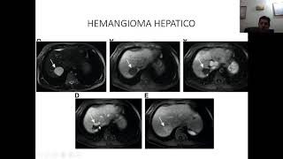 Teórico tumores hepáticos 2020 [upl. by Jenei365]