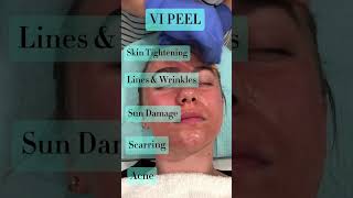 Vi Peel🌱 medandspaburrridge vipeel chemicalpeels burrridge antiaging [upl. by Alihs]