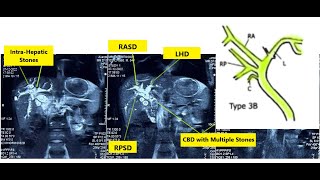 Hepatolithiasis Management – Hepatolithiasis Series 14  See Video Description for Details [upl. by Edlitam428]