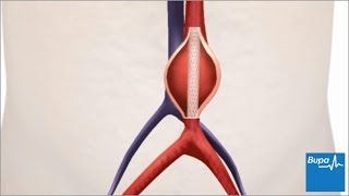 How keyhole abdominal aortic aneurysm surgery is carried out  Bupa Health [upl. by Acirt200]