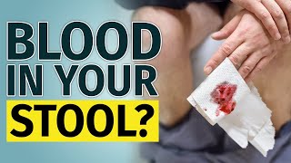 BLOOD IN STOOL  Other Signs You Have to Check [upl. by Ewens]