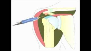 Acromioplastie arthroscopique de lépaule pour tendinite [upl. by Nairrot]