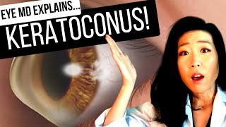 KERATOCONUS and What To Do About It  All About Cornea Crosslinking [upl. by Ynavoeg254]