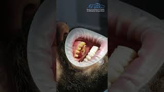 Full Mouth Rehabilitation in a Class III Patient  Dr Rami Albahri [upl. by Elatan]