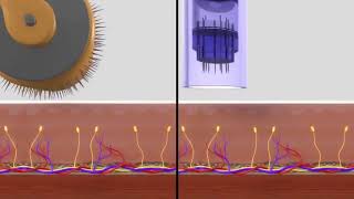 Dermapen v Dermaroller [upl. by Madora]