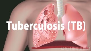 Tuberculosis TB Progression of the Disease Latent and Active Infections [upl. by Asylla]