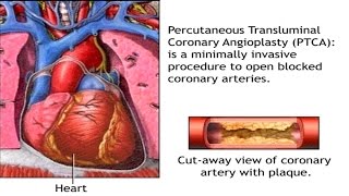 How Balloon Angioplasty is Done Animation  Coronary Angiography Procedure  Stenting in Heart Video [upl. by Ellette]