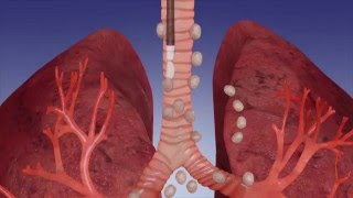 EBUS Procedure OverviewOlympus Bronchoscopy [upl. by Tori459]