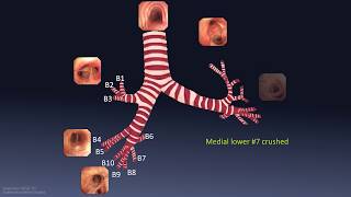 Mastering Bronchoscopy for Thoracic Surgery Chapter 1 [upl. by Arnoldo]