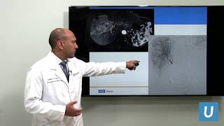 Minimally Invasive Treatment for Liver Cancer  Sid Padia MD  UCLAMDChat [upl. by Maxie]