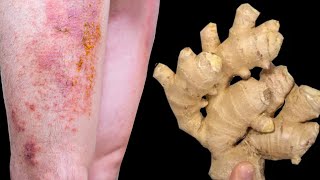 Never itch again Medicinal plant against eczema and neurodermatitis Healing from the inside [upl. by Eilesor]