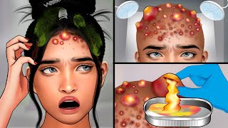 ASMR Head Acne Removal and Pimples Popping  Itchy Scalp Treatment ASMR [upl. by Cahilly]