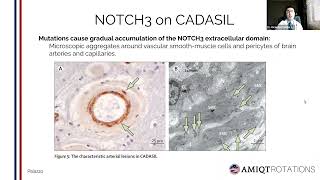 CADASIL  Stroke and Vascular Dementia in adults by Ricardo Carrillo Meza [upl. by Nylla339]