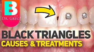 Tooth Gaps  Black Triangles with Braces or Invisalign [upl. by Naujled]