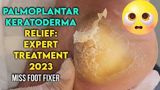 Palmoplantar Keratoderma Relief Expert Treatment for Thick Callus Removal by miss foot fixer [upl. by Sherar]