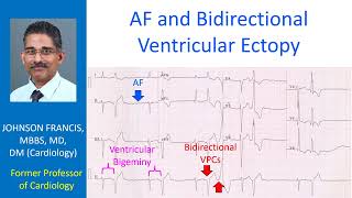 AF and Bidirectional Ventricular Ectopy [upl. by Anaidni988]