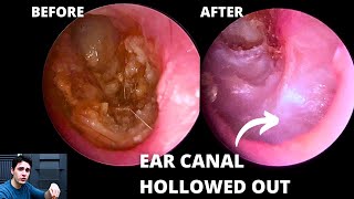 The Importance Of Angled Endoscopes Hidden Pathology [upl. by Edroi223]