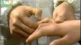 Acupuncture Video Course Lesson 30  Palpitation And Heart Bisyndrome [upl. by Denni]