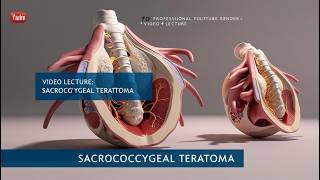 Sacrococcygeal Teratoma in 3D4D Sonography [upl. by Notsej]