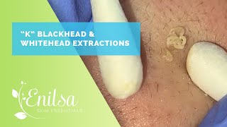 Blackhead amp Whitehead Extractions on quotKquot Part 3 [upl. by Joly]